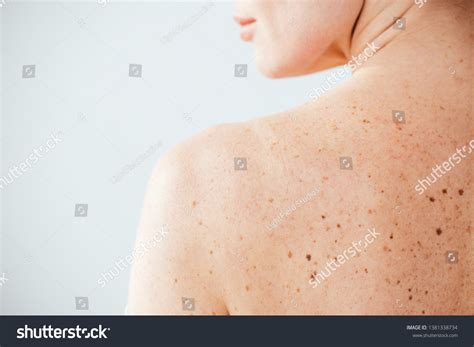 Cropped View Diseased Naked Woman Moles Stock Photo 1381338734