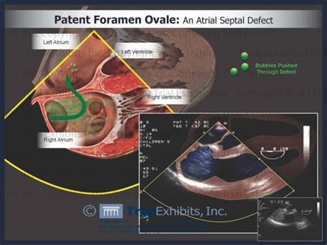 25 Bästa Patent Foramen Ovale Idéerna På Pinterest Nicu Nursing