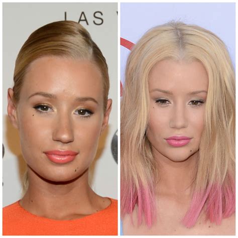 Iggy Azalea Opens Up About Her Nose Job Im Not Denying It