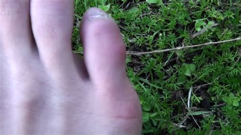 The wide spectrum of possibilities include the following: My Broken Toe - YouTube