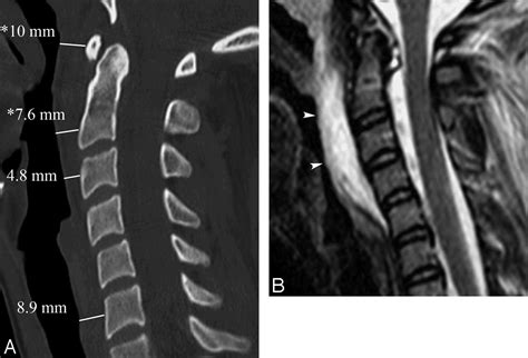 Normal Thickness And Appearance Of The Prevertebral Soft Tissues On