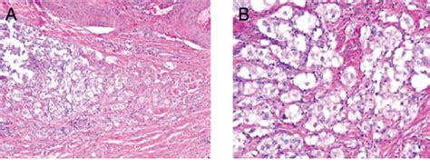 Figure 2 From Malignant Perivascular Epithelioid Cell Tumor Of The