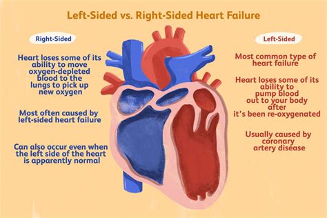 Left Vs Right Sided Heart Failure