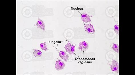 Trichomonas Sexually Transmitted Parasite Infection Youtube