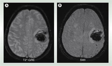 Cerebral Microbleeds Detection Mechanisms And Clinical Challenges