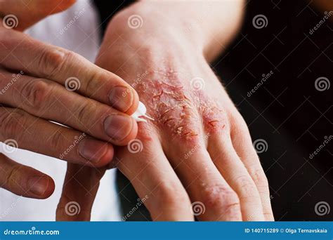 Eczema Sulle Mani Luomo Che Applica Lunguento Screma Nel Trattamento