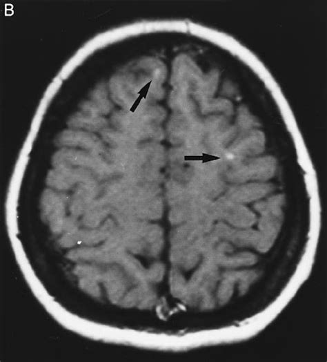 Periventricular Callosalsubcallosal And Ovoid Lesions The T 2