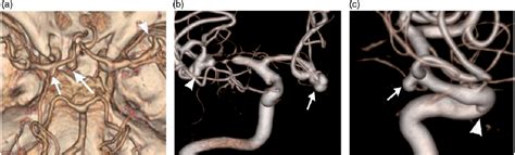 Figure From Section Multidetector CT Angiography For Evaluation Of Intracranial Aneurysms