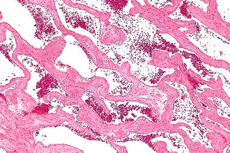 Hemangioma Of The Liver Libre Pathology