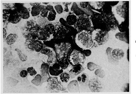 Figure 1 From Abnormal Erythropoiesis And Eosinophilia Report Of Two