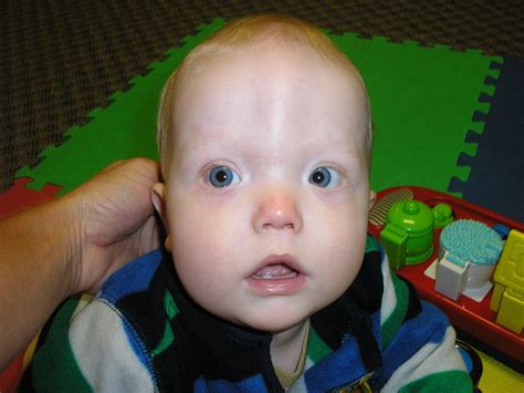 The Truth About Tummy Time Plagiocephaly And Craniosynostosis