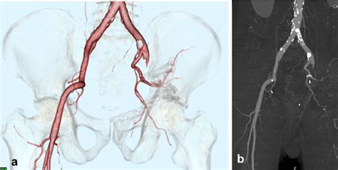 A Three Dimensional Computed Tomography Ct Angiogram Reconstruction