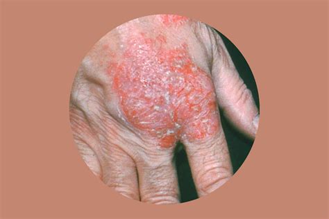 Nummular Eczema How To Get Rid Of It For Good The Healthy