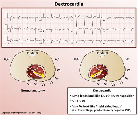 Dextrocardia On Ekg Limb Leads Look Like La ←→ Grepmed