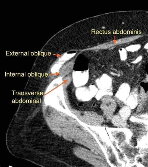Spigelian Hernia Radiology Reference Article