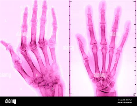 Rheumatoid Arthritis Hands X Ray Hi Res Stock Photography And Images