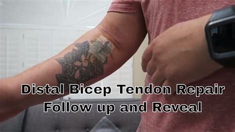 My Distal Bicep Tendon Rupture And Repair Day Of Follow Up Youtube