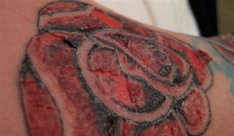 Tattoo Ink Poisoning Its Causes Symptoms And Treatment