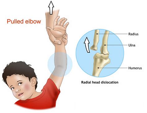 Dislocated Elbow Causes Signs Symptoms Recovery And Treatment