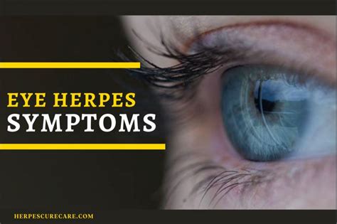 Insane But True Things About Eye Herpes You Should Know