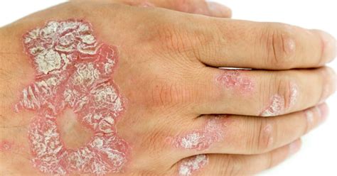 Types Of Mild Psoriasis Treatment Symptoms And Pictures