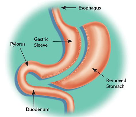 Roux En Y Gastric Bypass Vs Sleeve Gastrectomy Which One Is Best For You