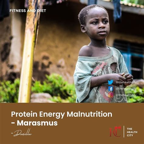 The Health City Protein Energy Malnutrition Marasmus