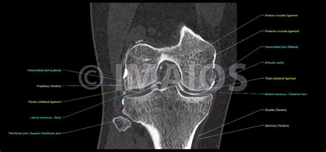 Tips to keep joints healthy. Anatomy of the knee (CT arthrography)