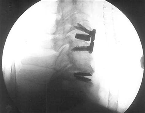 Cirugía Avanzada De Columna Cervical Icac