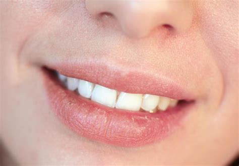 What Are Common Dry Lips Symptoms With Pictures