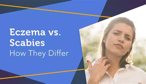 Eczema Vs Scabies How They Differ Myeczemateam