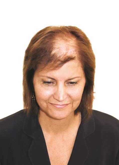 What To Do About Lupus Hair Loss • Southwest Floridas Health And