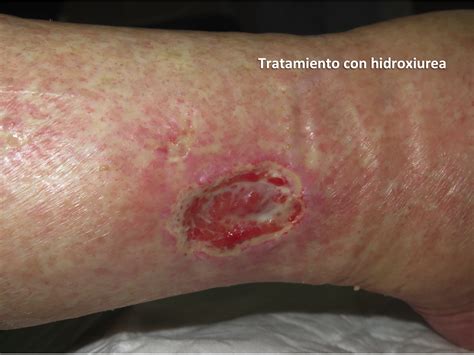 Fotos De Ferida Macerada