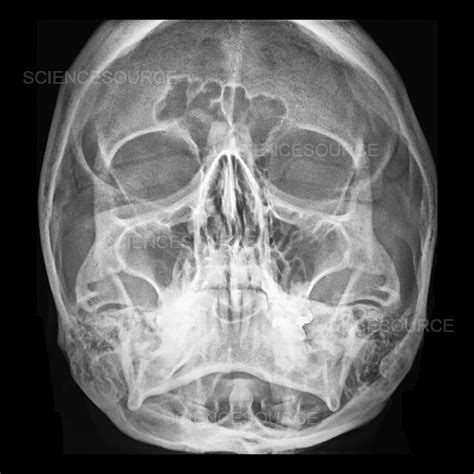 Photograph Normal Skull X Ray Science Source Images