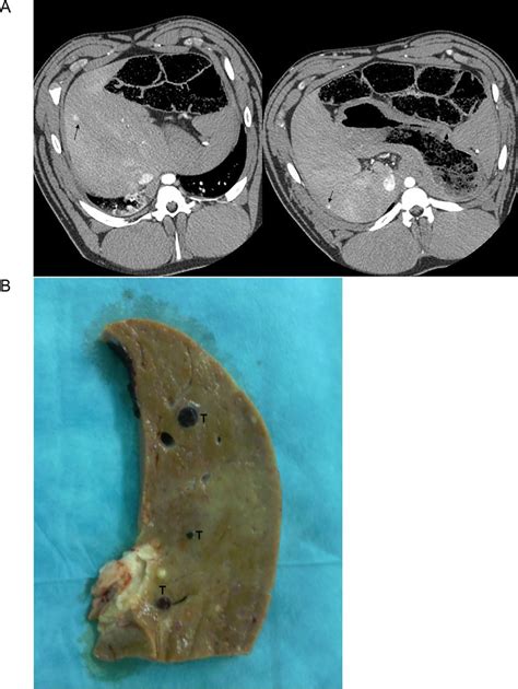 Ct Scans And Macroscopic Visualization Of Liver Lesions A Ct Scans