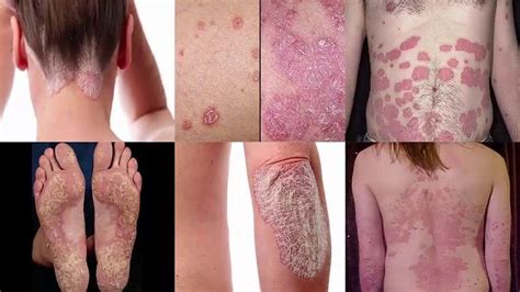 Psoriasis Treatment In India How To Cure Psoriasis Permanently