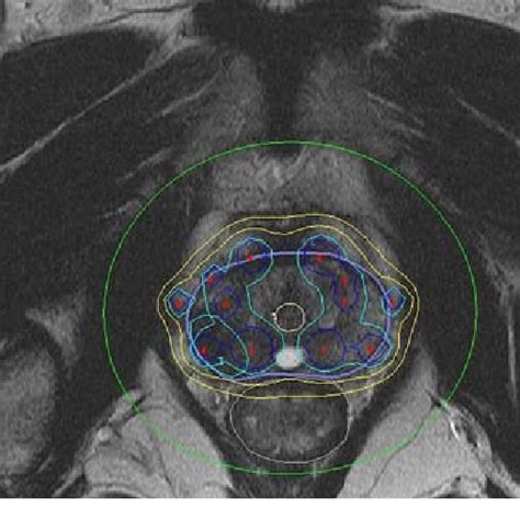 Standard 3d Conformal External Beam Radiotherapy Of The Prostate