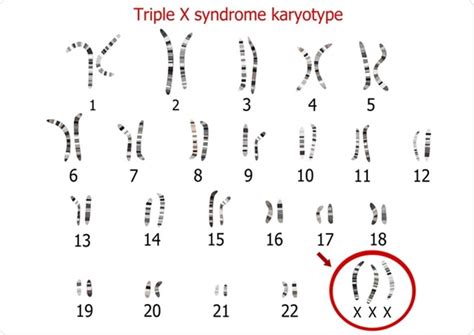 Herenciageneticayenfermedad What Is Triple X Syndrome