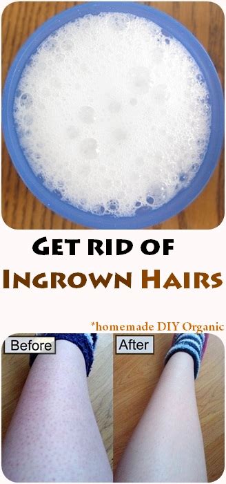 Get Rid Of Ingrown Hairs Fashion Accessories And Style