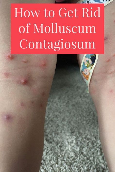 How To Get Rid Of Molluscum Contagiosum How To Get Rid Essential