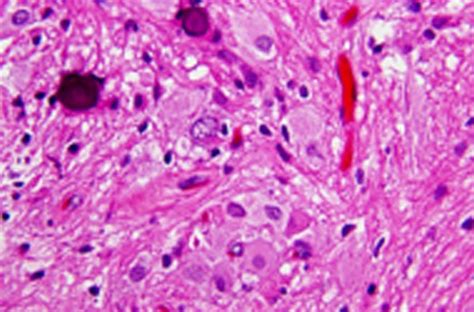 Subependymal Giant Cell Astrocytoma