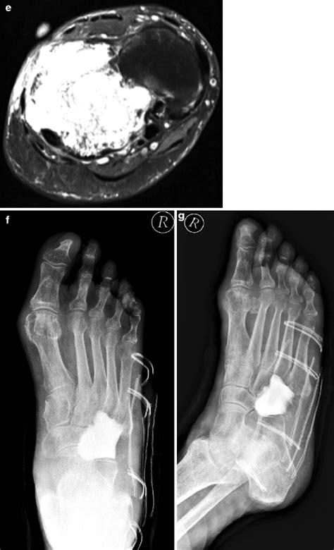 Tumors And Tumor Like Lesions Of The Foot And Ankle Diagnosis And
