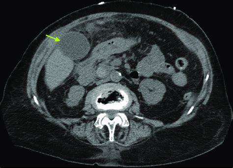 Ct Scan Showing Distended Gallbladder Arrow And Inflammatory Changes