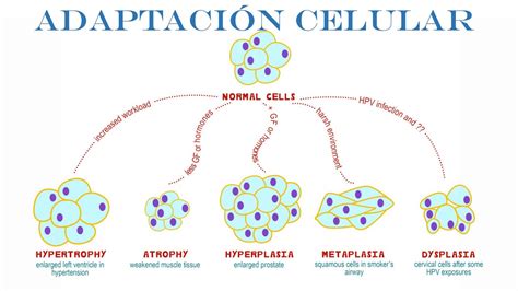 Adaptaci N Celular Patolog A Hiperplasia Metaplasia Displasia
