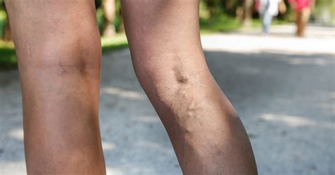 Varicose Veins And Blood Clots In Your Leg The Iowa Clinic