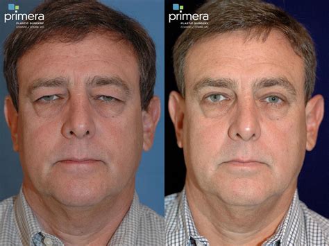 Blepharoplasty Before And After Pictures Case 123 Orlando Florida