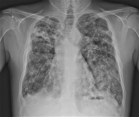 Dextrocardia, (from latin dexter, meaning right, and greek kardia, meaning heart) refers to a condition in which the heart is on the right side of the mediastinum. Chest X-ray at hospital admission, showing areas of old ...