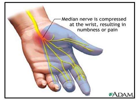 Carpal Tunnel Syndrome Zyex Physiotherapy And Rehabilitation Center