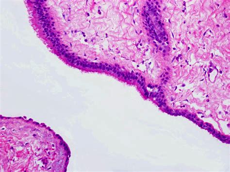 Pathology Outlines Surgical Ciliated Cyst