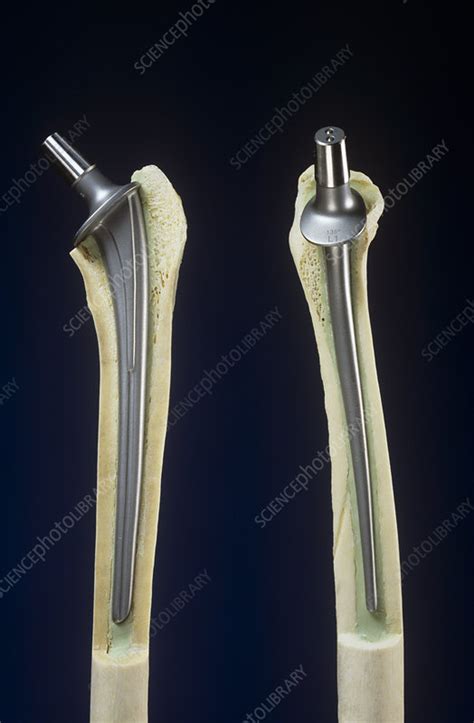 Artificial Hip Joints Stock Image M6000301 Science Photo Library